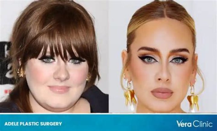 Adele Plastic Surgery: Her New Look Sparks Plastic Surgery Speculation!
