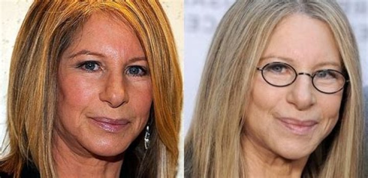 Barbra Streisand Plastic Surgery: Debunking the Facelift Rumors and Wrinkle-Free Speculations