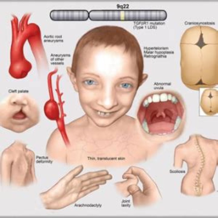 Brooke Roth Died of Loeys–Dietz Syndrome, University of Miami student