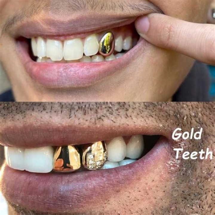 Does Joe Pesci have a gold tooth? – Celebrity