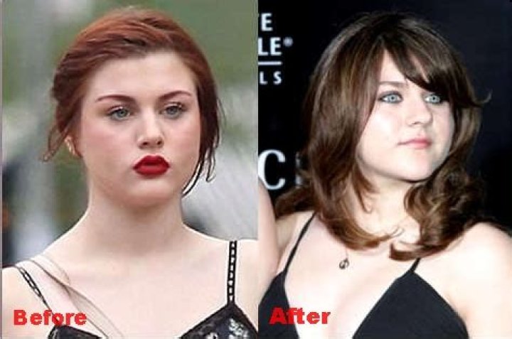Frances Bean Cobain Nose Job Plastic Surgery Before and After