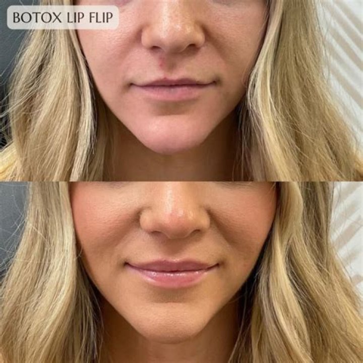 
Has RHOBH Brandi Glanville Had Botox And Lip Fillers? Fans Curious Of Beauty Secret After Her Transformation 