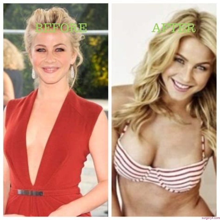Julianne Hough Plastic Surgery Before and After