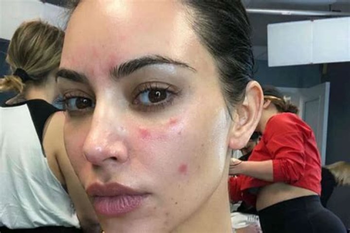 Kim Kardashian Opens Up About Her Struggle With Psoriasis – ‘The Pain Was So Unbearable’