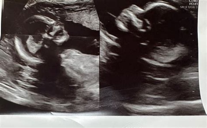 Lil Xan’s Pregnant Fiancée Annie Smith Addresses The Ultrasound Photoshopping Accusations!