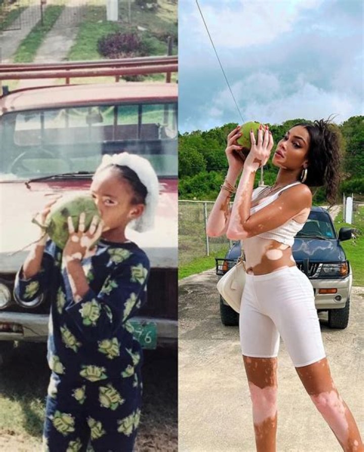 Meet Winnie Harlow, a Supermodel With Vitiligo, Who Has Been Fighting With Beauty Stereotypes Since