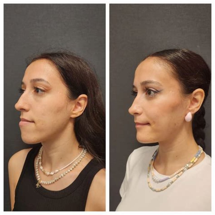 Sophie Rundle Plastic Surgery: Has She Done Jaw Surgery And Botox