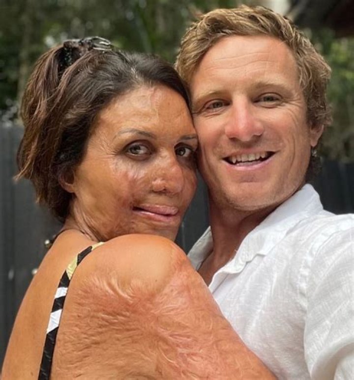 The Unbelievable Story of Turia Pitt and Her Husband Whose Love Helped Her to Survive a Deadly Fire