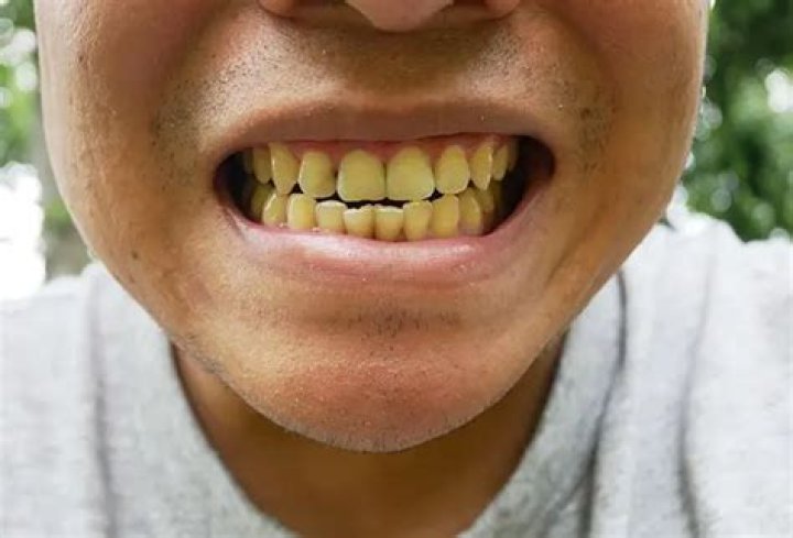 Why Do Redheads Have Yellow Teeth? – Celebrity